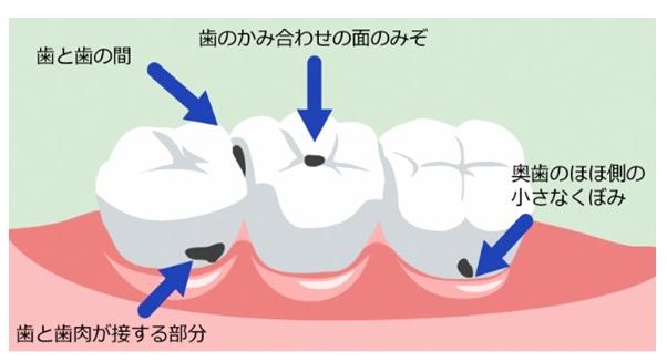 磨き残し